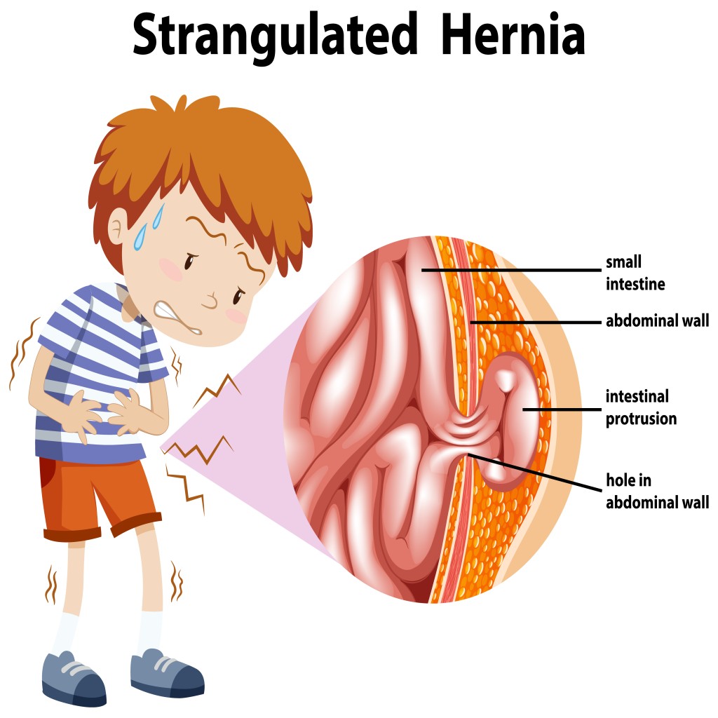 Hernia