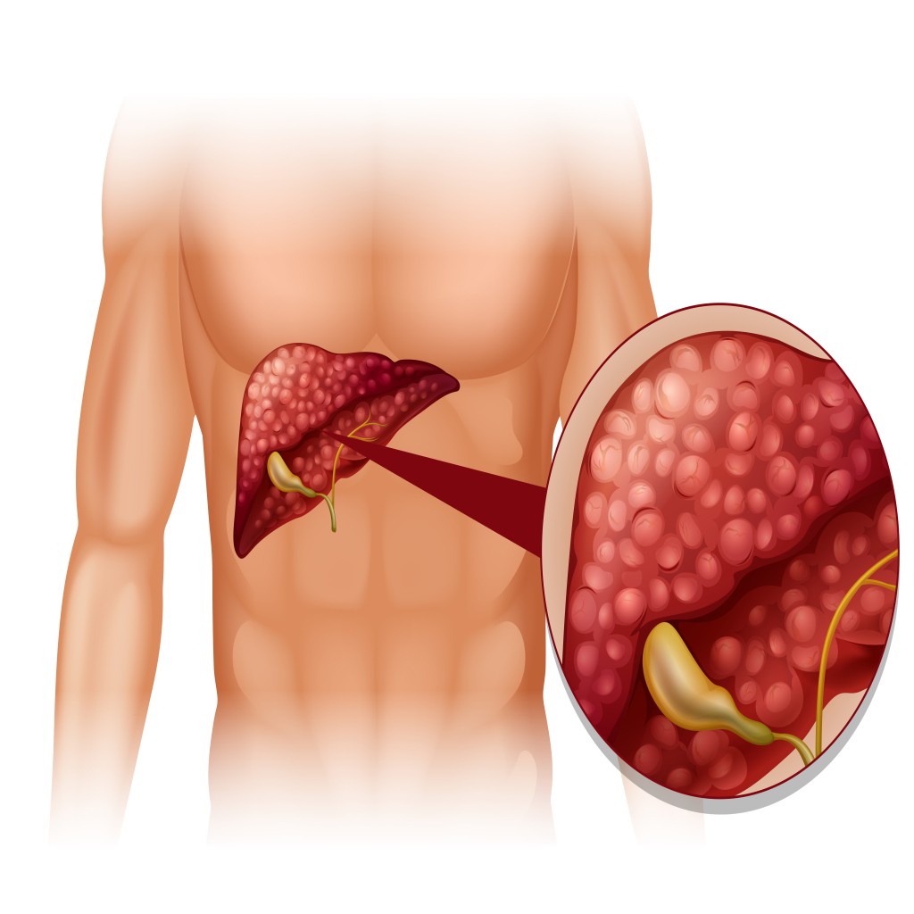 Cholecystitis