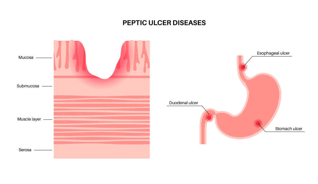 Perforated Ulcers - BRUNDAVAN Nursing Home